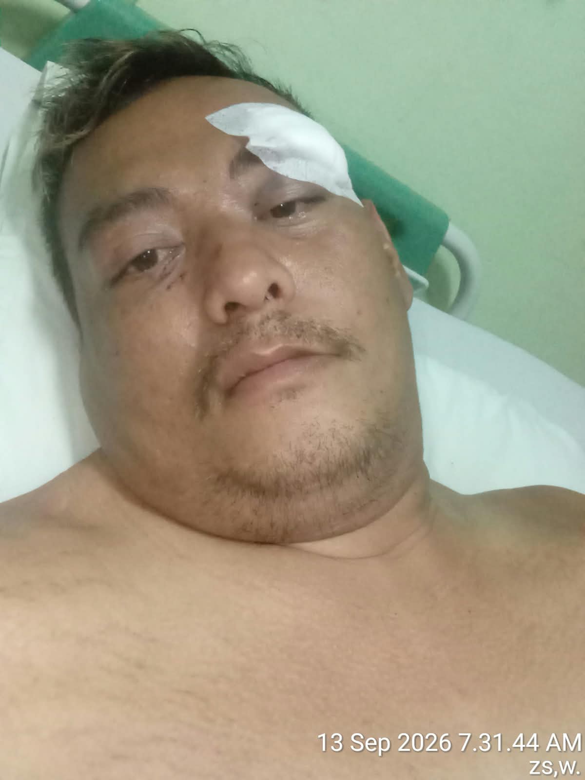 Paru Paru Bocor Diduga Akibat Hantaman Linggis bertubi tubi, Kondisi Memprihatinkan Sholeh Korban dugaan Pengroyokan Di Parkiran Benang Raja Salatiga, Polresta Salatiga Belum Menangkap Pelaku.
